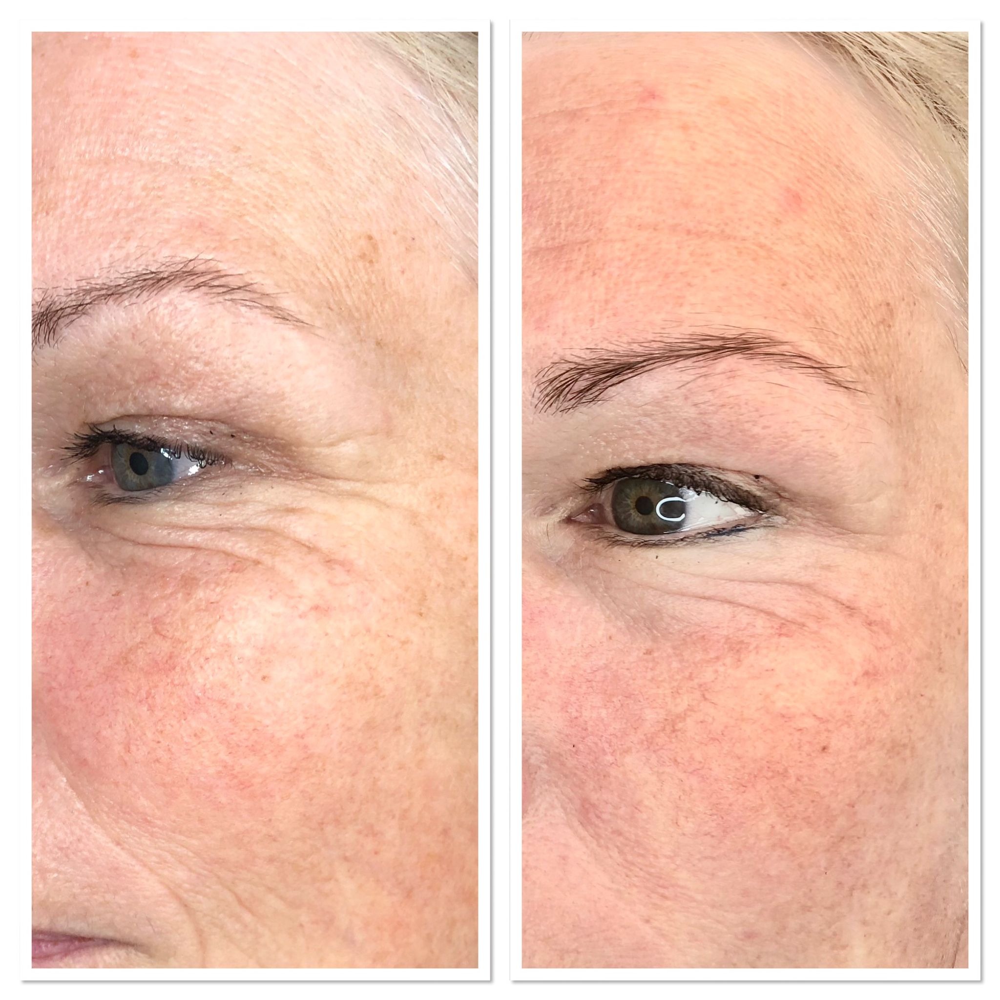 Skin firmor voor en na Skinformer voor en na